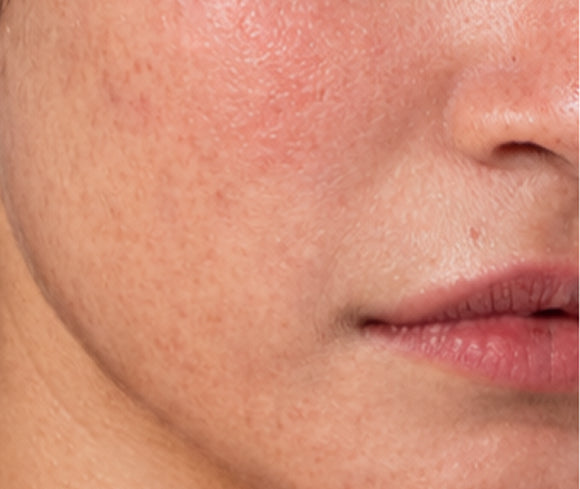 Skin before using the Hydrating Barrier Cream